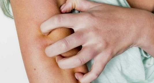 eczema and sauna