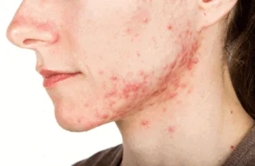 Are saunas good for acne?