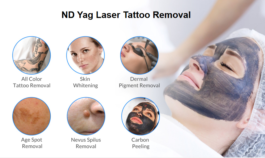 nd yag laser tattoo removal machine