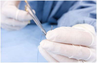 Surgical Suture 3