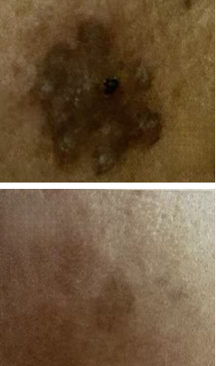 fractional laser before and after