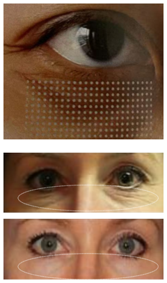 fractional laser before and after