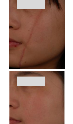 fractional laser before and after