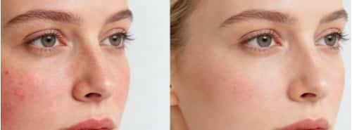 Sensitive Skin & Hyperpigmentation