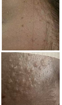 fractional laser before and after