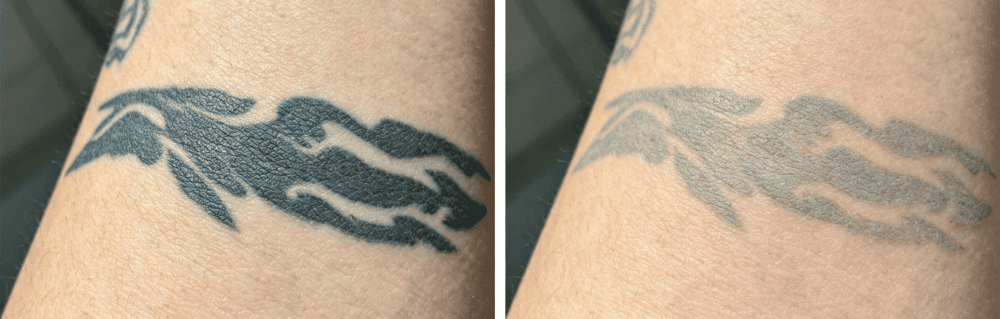 Tattoo Removal Results: Before-and-After Comparison