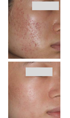 fractional laser before and after