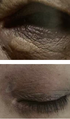 fractional laser before and after