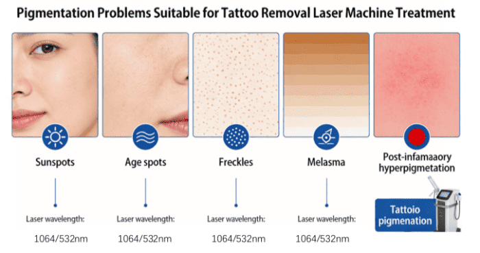 List of Pigmentation Problems Suitable for Treatment with a Tattoo Removal Laser Machine