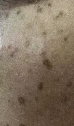 fractional laser before and after