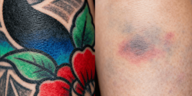 what is q switch laser treatment