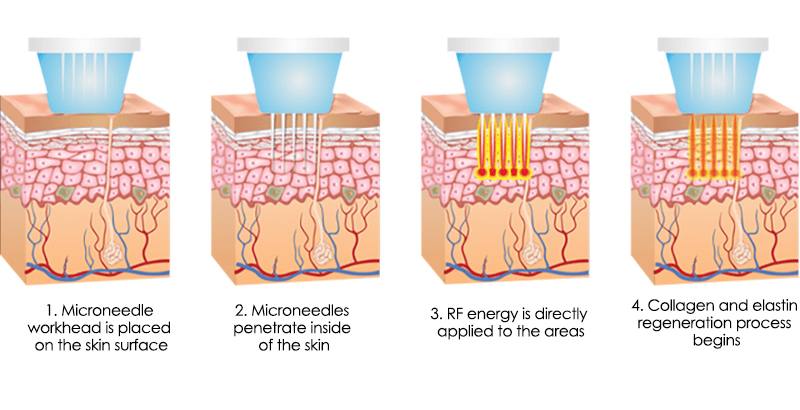 How does Morpheus 8 radiofrequency microneedle work?