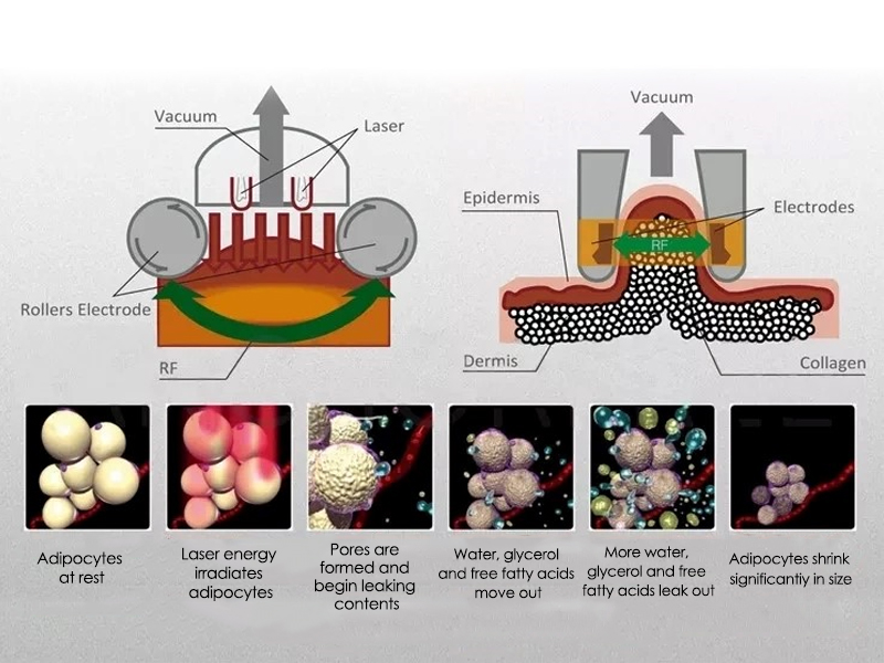 velashape body Shaping working principle