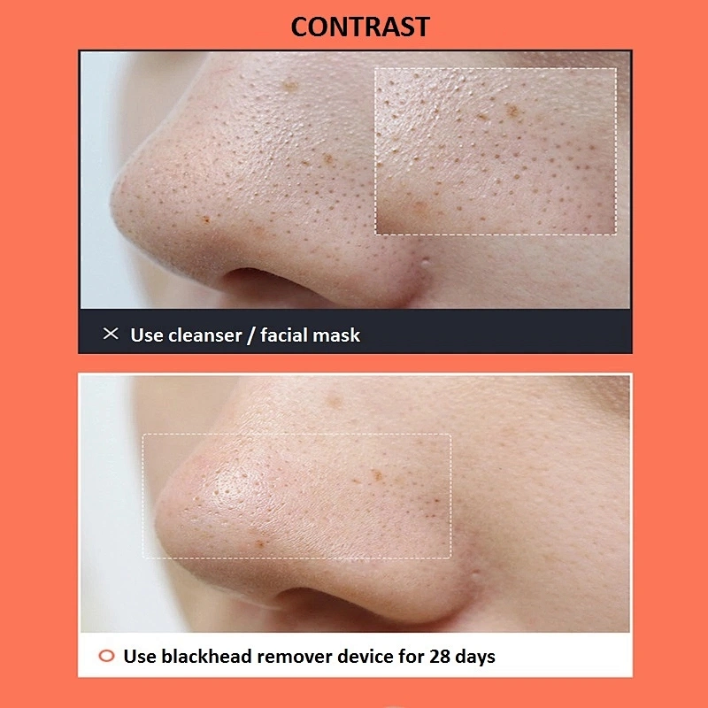TED-216 Blackhead Remover