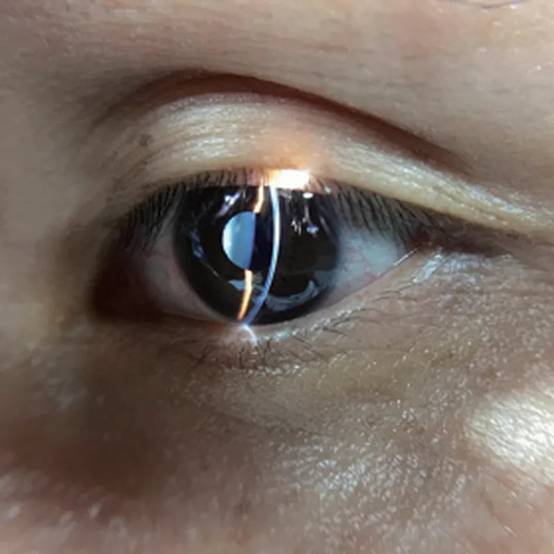 CCE-S150 Portable Slit Lamp rechargeable Online Ser... CCE-S150 Portable Slit Lamp rechargeable