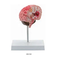 Cerebral apopleksi
