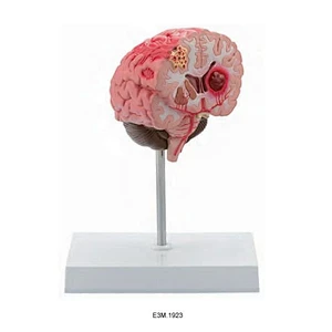 Apoplexy Serebral
