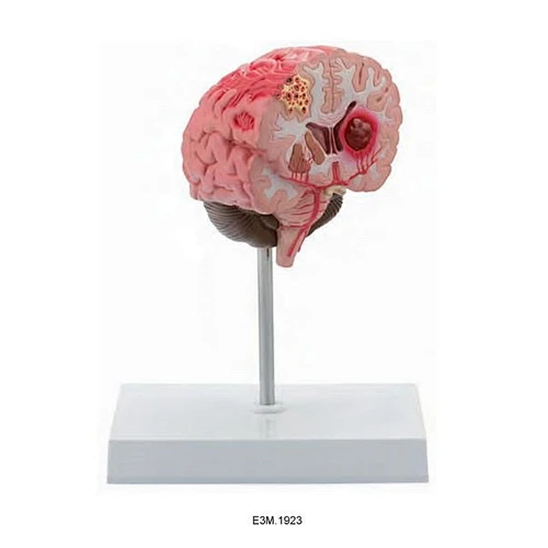 Cerebral apopleksi