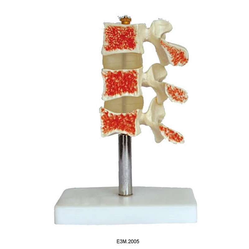 Osteoporosis Potongan