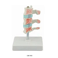 Avansert osteoporosemodell
