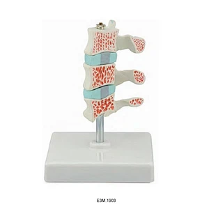 Avanceret osteoporosemodel