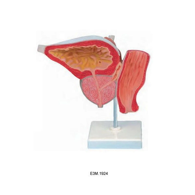 Model Hiperplasia Prostatik