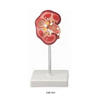 Renal Calculus Model