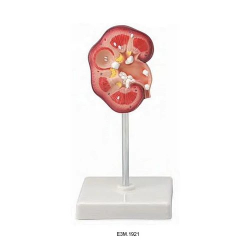 Renal Calculus Model