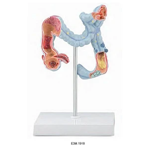 Pagkabulok ng Colon