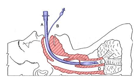 endotracheal tube types