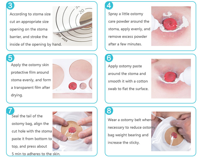 useful colostomy bags