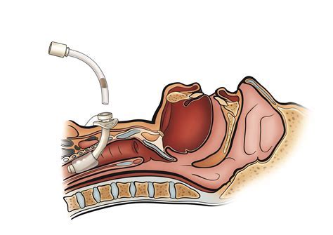 tracheostomy tube