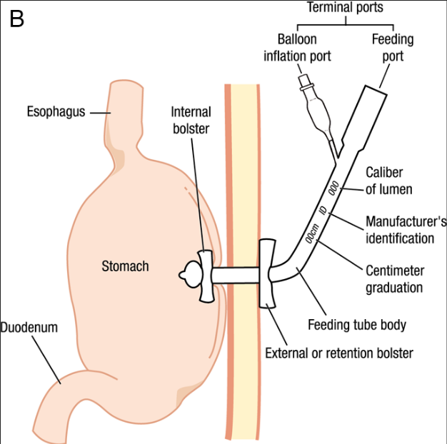pvc medical stomach catheter