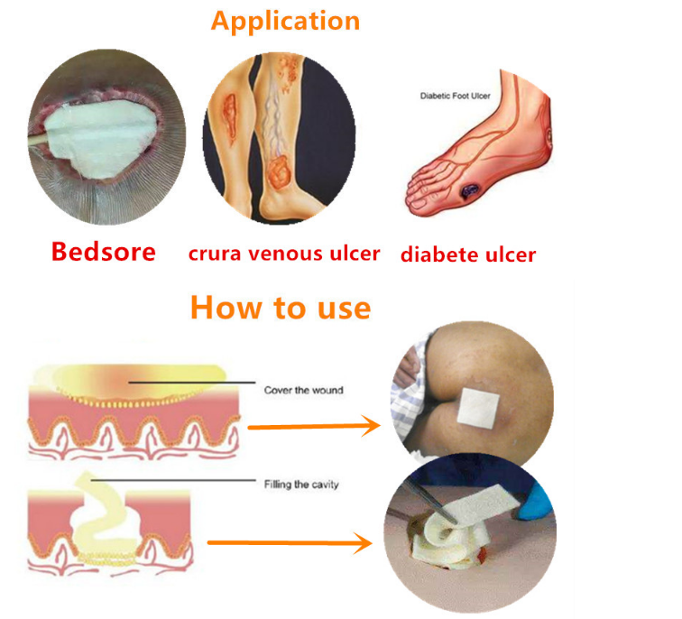 medical Alginate Wound Dressing.png