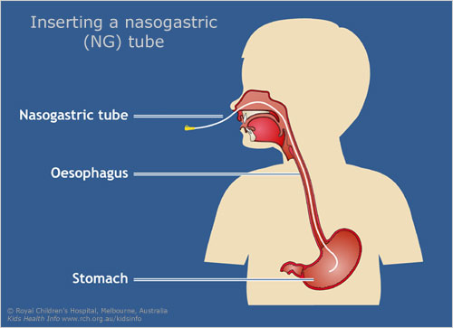 pvc feeding tube