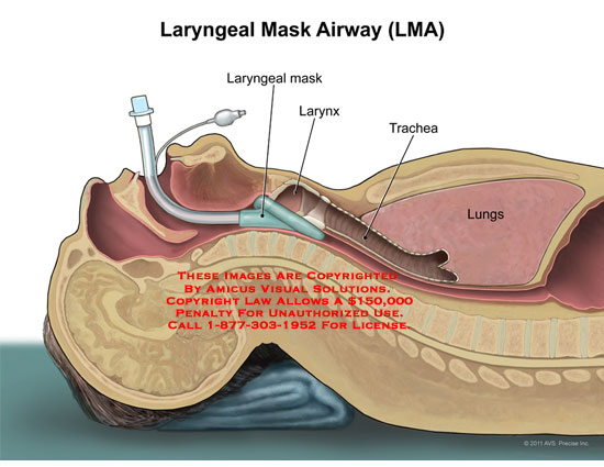 laryngeal