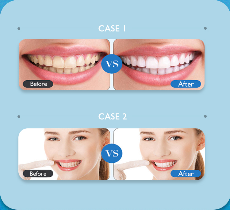 teeth whitening gel