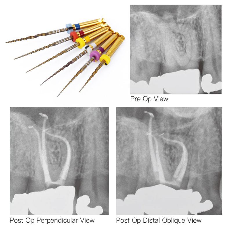 root canal kfile h file