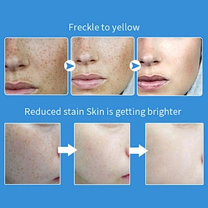 OEM/ODM KanjN Private label anti freckle face cream Melasma removing whitening freckle cream
