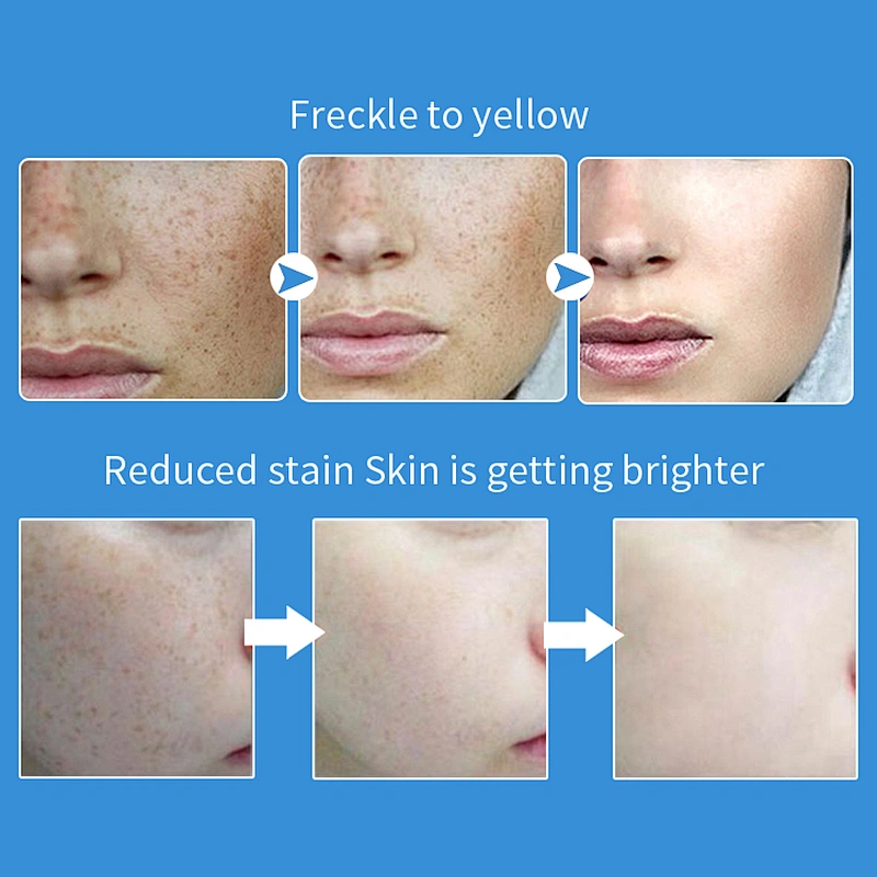 OEM/ODM KanjN Private label anti freckle face cream Melasma removing whitening freckle cream