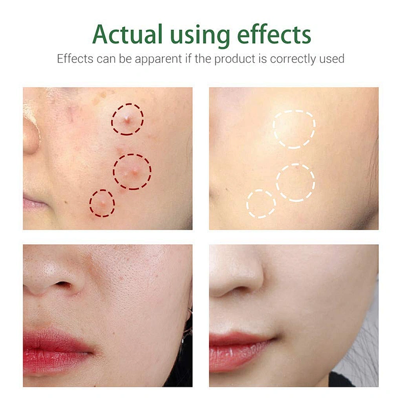 Factory Supply Acne Treatment Facial Cleanser Private Label