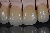 anterior teeth