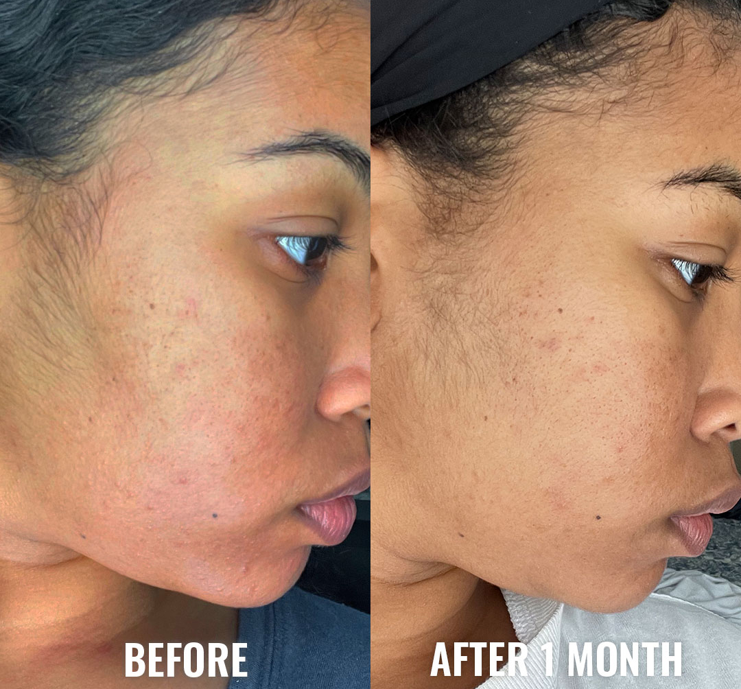 Salicylic Acid Anti-Acne Set