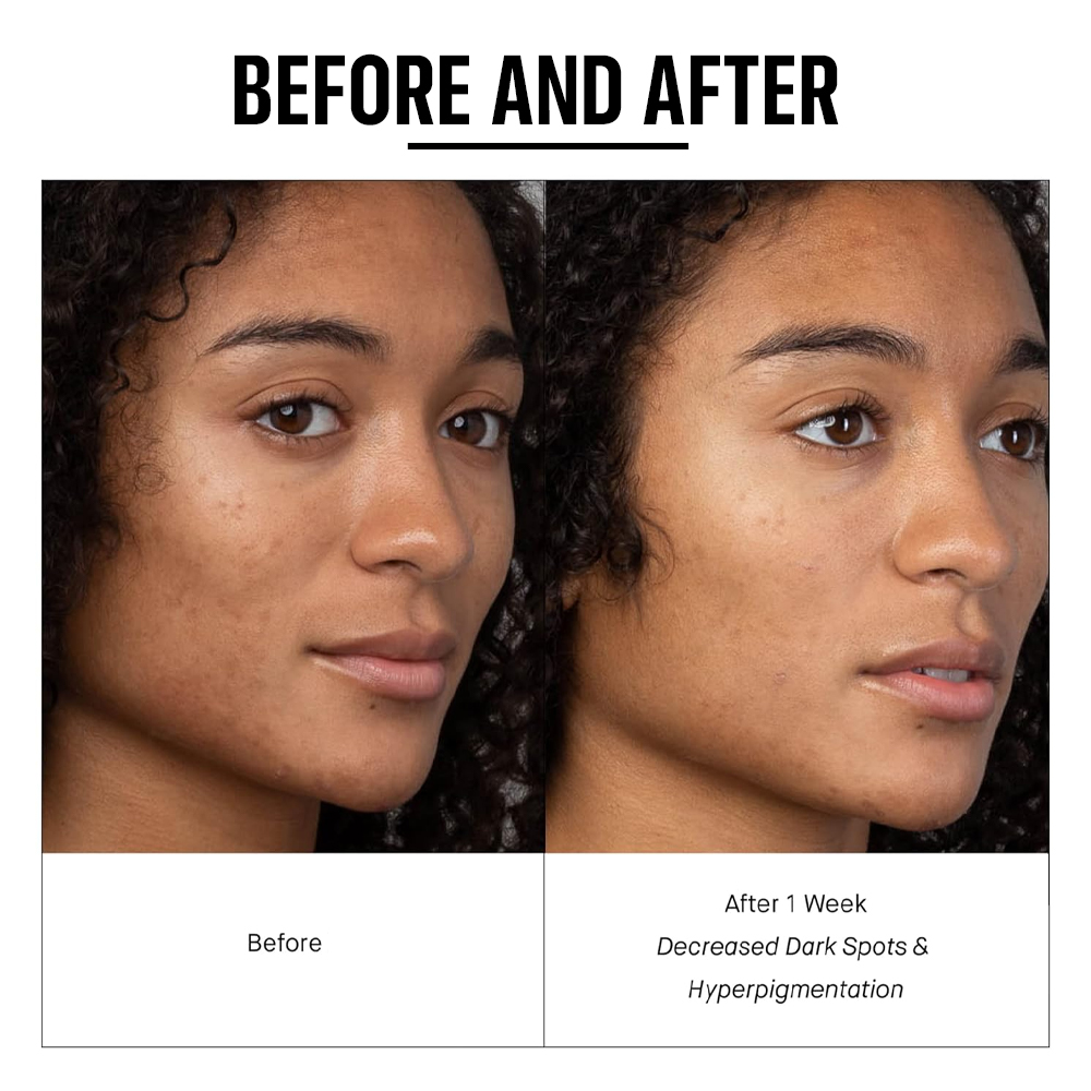 Lactic Acid Serum