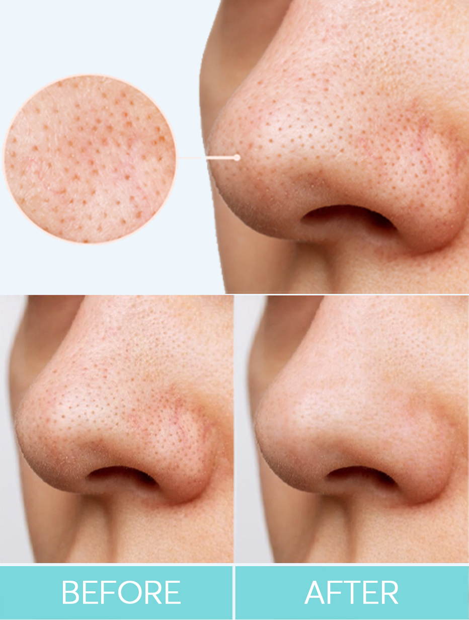 Blackhead Purifying