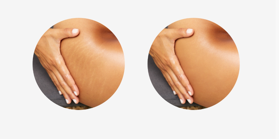 Stretch Mark Body Oil