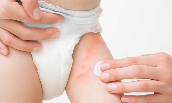 Eczema Cream