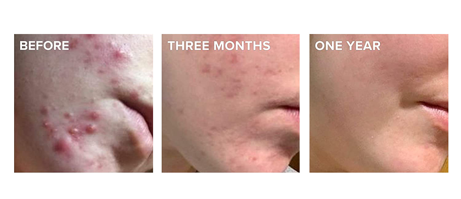 ACNE TREATMENT SKIN CARE SET