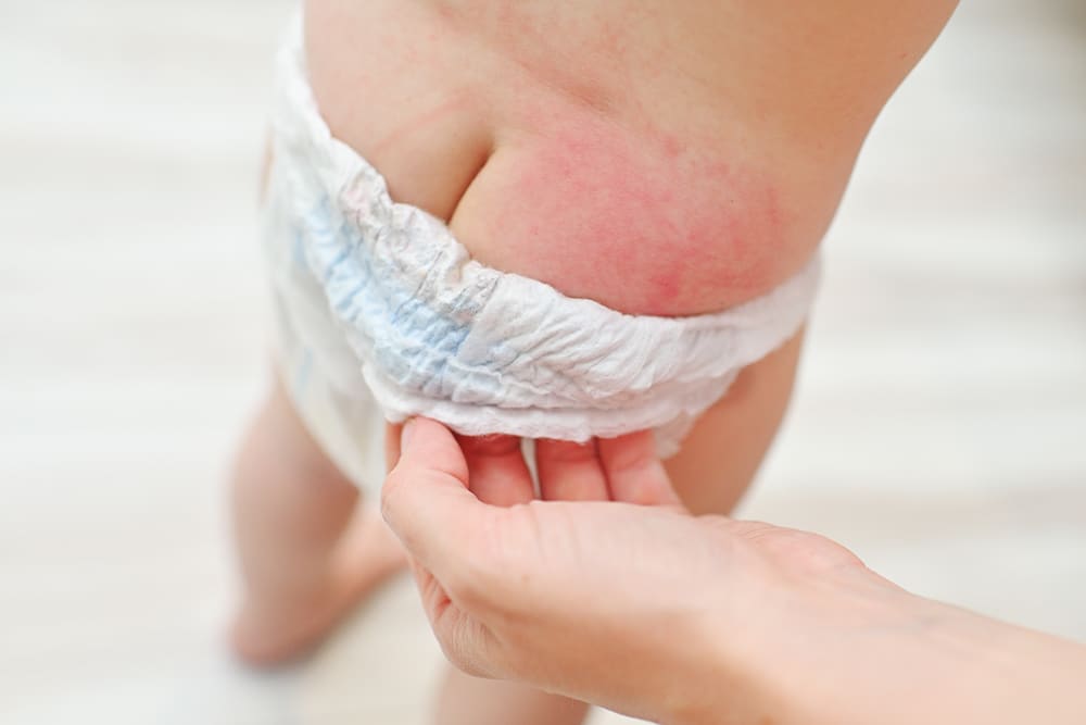 Eczema Cream