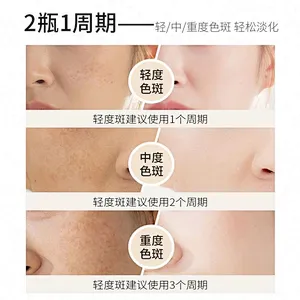 OEM ODM Beauty Anti Freckle Treatment Removal Cream Freckle Whitening Cream